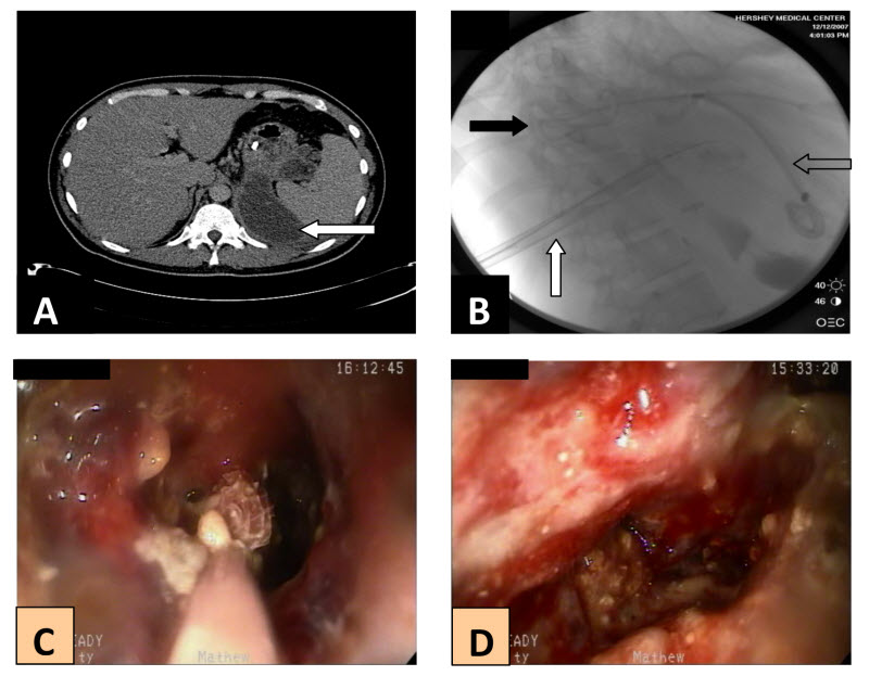 Figure 1. A, initial CT revealing a multi-locular pseudocyst extending from the lesser sac to the splenic hilum (arrow). B, Fluoroscopic image showing the drainage catheter previously placed under CT guidance (black arrow), fluoroscopically placed 30Fr introducer sheath (white arrow), and the previously placed transgastric pig-tailed stents (clear arrow). C, endoscopic view of the Roth net removing necrosum from deep inside the abscess. D, interior of the abscess cavity after removal of a majority of the debris.