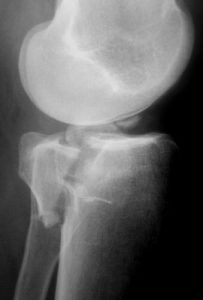 Figure A: Posteromedial tibial plateau fracture radiograph