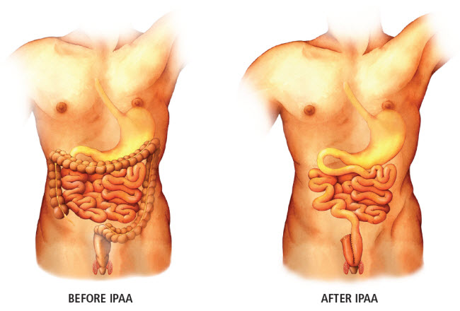 Before and after IPAA images of the gastrointestinal tract.