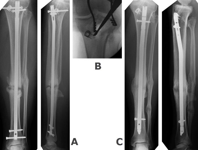 X-ray images of initial fracture repair and post-procedure result.