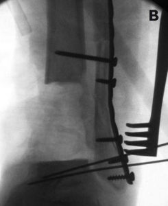 Figure B: an xray of an ankle joint with a combination of the Ilizarov and Taylor spatial frame.