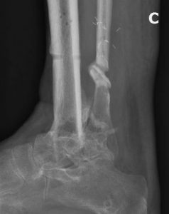 Figure C: An xray shows the excellent position of the ankle fusion.
