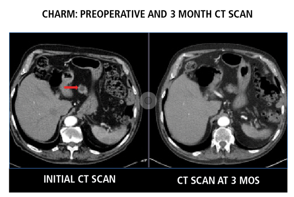 Preoperative CT scan showing a mucinous pancreatic lesion (left, red arrow) in CHARM patient with near complete resolution by three months post ablation (right)