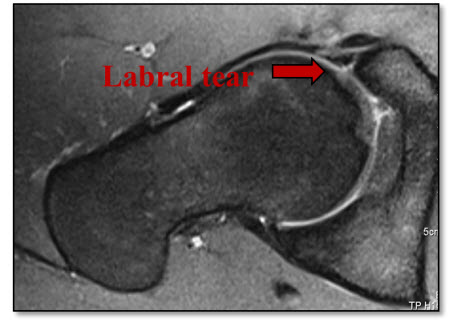 Labral tear: hip labrum-450w