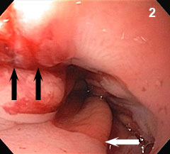 Figure 2: A linear esophageal disruption