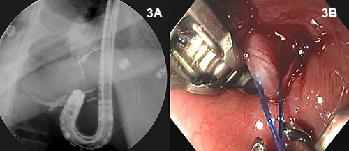 Figure 3A and 3B: The esophageal injury distal to the gastroesophageal junction is repaired by endoscopic suturing in the retroflexed position.
