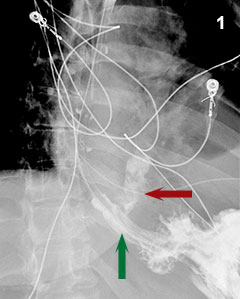Figure 1: High-grade disruption of the distal esophagus