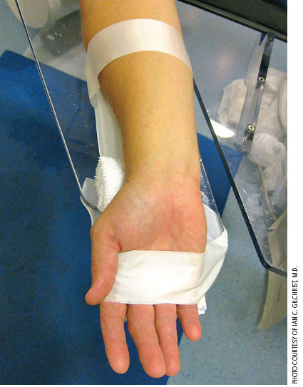 Photo of a wrist prepped for transradial artery catheterization for PCI.