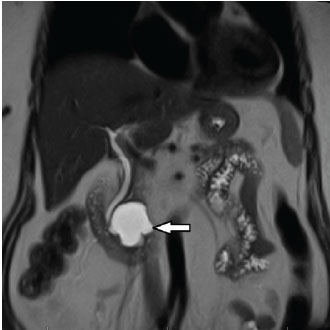 CHARM image 1: 76-year-old female with a 4.2cm mucinous (premalignant type) pancreatic cyst (white arrow) prior to EUS-guided chemoablation in the Penn State CHARM trial.