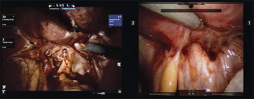 Obliterated cul-de-sac in stage IV endometriosis