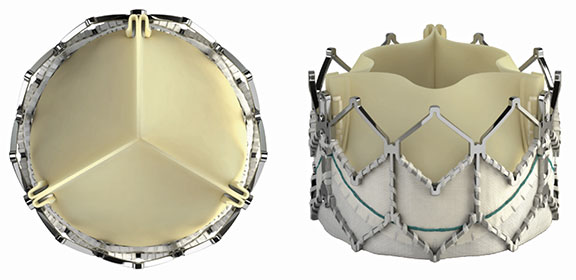 An image of SAPIEN-XT-Valves. Pictured left: top view of SAPIEN-XT-Valve. Pictured Right: Front view of SAPIEN-XT-Valve.