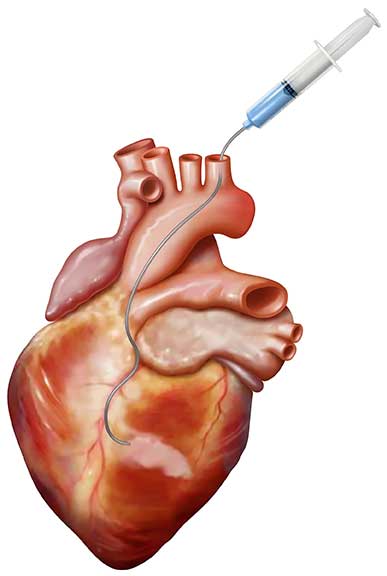 An illustrative image of a human heart undergoing the Bellerophon Therapeutics Bioabsorbable Cardiac Matrix procedure.
