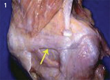 Medial Patellofemoral Ligament - Figure 1