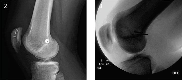 Medial patellofemoral ligament restructure, Figures 2 and 3.