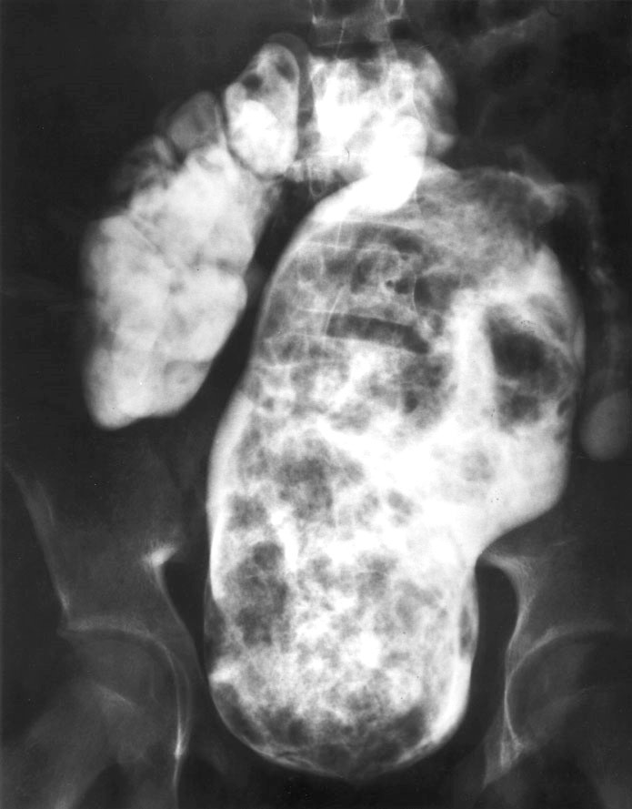 Radiographic image showing severe constipation distending the rectum in a pediatric patient.