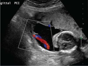 Routine Identification of Placental Umbilical Cord Insertion Location ...