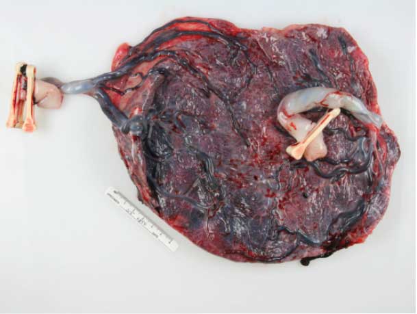 Figure B: Photograph of delivered placenta at 29 weeks.