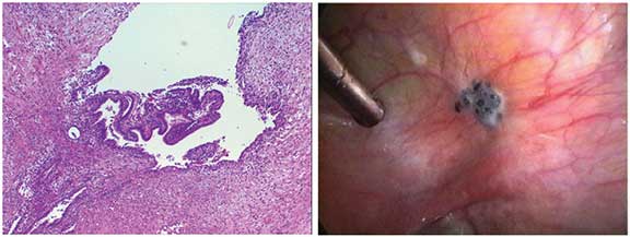 Pathology slide of endometriosis and picture of an endometriosis lesion