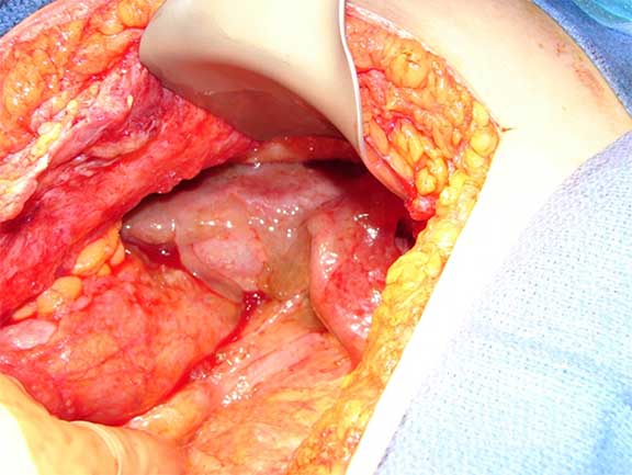 Image of mucin covering the liver