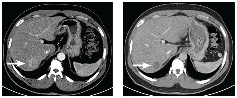 Image on the left: Pre-chemoembolization axial, contrast-enhanced CT scan at the level of the liver. Image on the right: Post-chemoembolization axial, contrast-enhanced CT scan at the same level as the previous image.