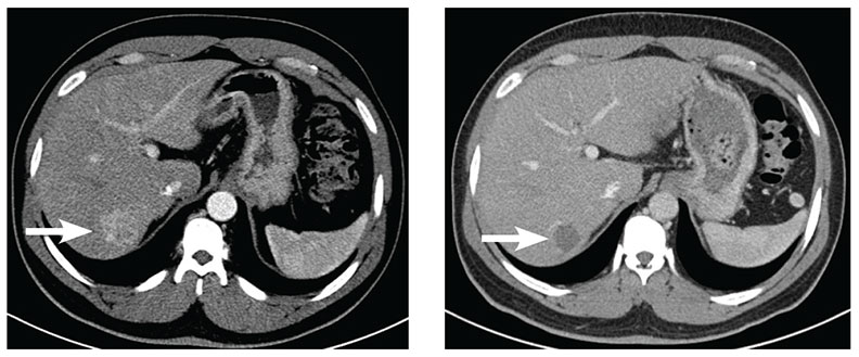 Comparison of Liver Tumor Motion With and Without Abdominal