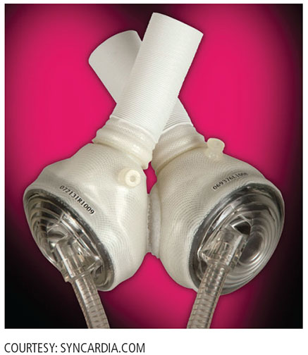 Total Artificial Heart: Procedure and Outlook