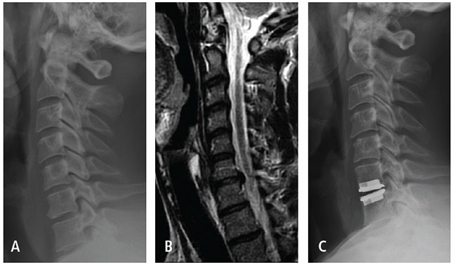 Images of: Patient is a healthy, active 40-year-old male with history of radiating right arm pain in a C7 nerve root distribution. He failed conservative treatment. (A) Pre-operative X-ray shows mild spondylosis at C6-7 with preserved disc height. (B) Pre-operative MRI shows a foraminal disc herniation at C6-7. Patient chose to undergo anterior cervical discectomy and disc replacement at C6-7 with complete relief of his right arm symptoms. (C) Follow-up X-ray at 2.5 years after surgery shows no evidence of device-related complications.