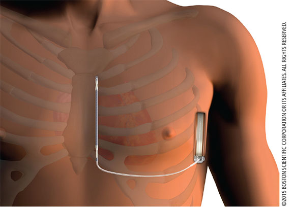 Image of male chest with EMBLEM (TM) S-ICD device implanted.