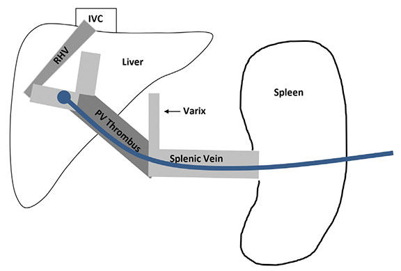 Innovative Solution To Treat Portal Vein Hypertension Medical Update