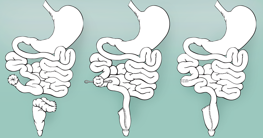 A medical illustration shows the first, second and third stages of the standard IPAA procedure via close-up drawings of the small and large intestines and rectum in an outline of the human abdomen. The first stage is illustrated on the left, with the colon removed and the rectum temporarily closed off. The middle illustration shows the second stage, with an internal reservoir and a temporary loop ileostomy. The right-hand illustration shows the third stage of the procedure, where the ileostomy is closed, and the reservoir is connected to the small intestine.