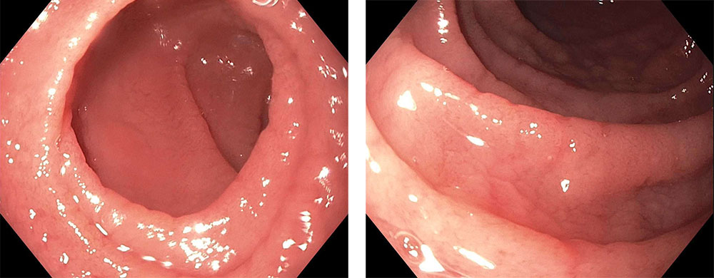 Two similar photographs taken during an endoscopy of the duodenum in a patient with celiac disease. The tissue has a scalloped appearance, characteristic of celiac disease.