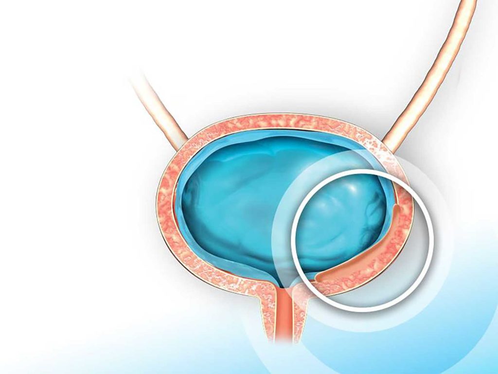 The image shows the bladder with the hydrogel drug inserted. There is a circle around the bladder tumor. The drug embedded in hydrogel may increase contact dwell time.