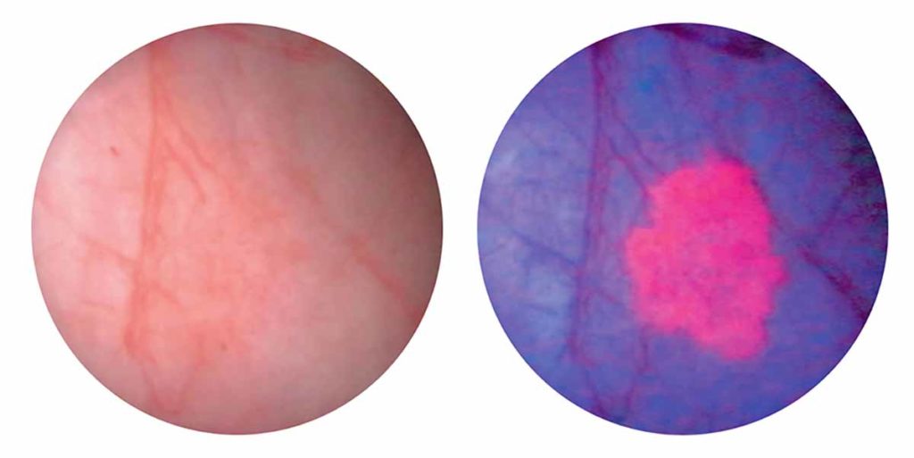 The image shows two views of the bladder. The image on the left is of the bladder using white light cystoscopy alone. It does not show any visible abnormality. The image on the right is the same image using Blue Light Cystoscopy with Cysview. The blue light causes the bladder to fluoresce, revealing a lesion near the center.