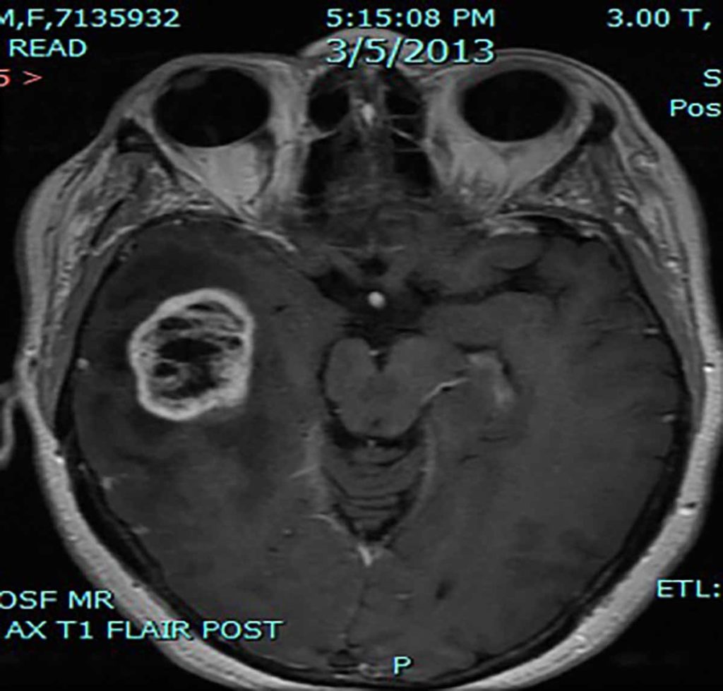 MRI scan of the head showing a Glioblastoma multiforme.
