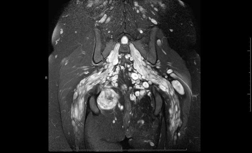 An MR image of a patient with neurofibromatosis. A large round tumor is shown in the lower left of the image. The tumor was malignanat and removed after chemo and radiation.