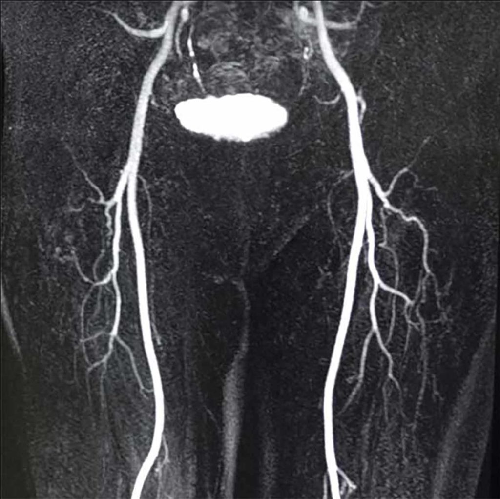 An ultrasound image of biomarkers in patients with restless leg syndrome