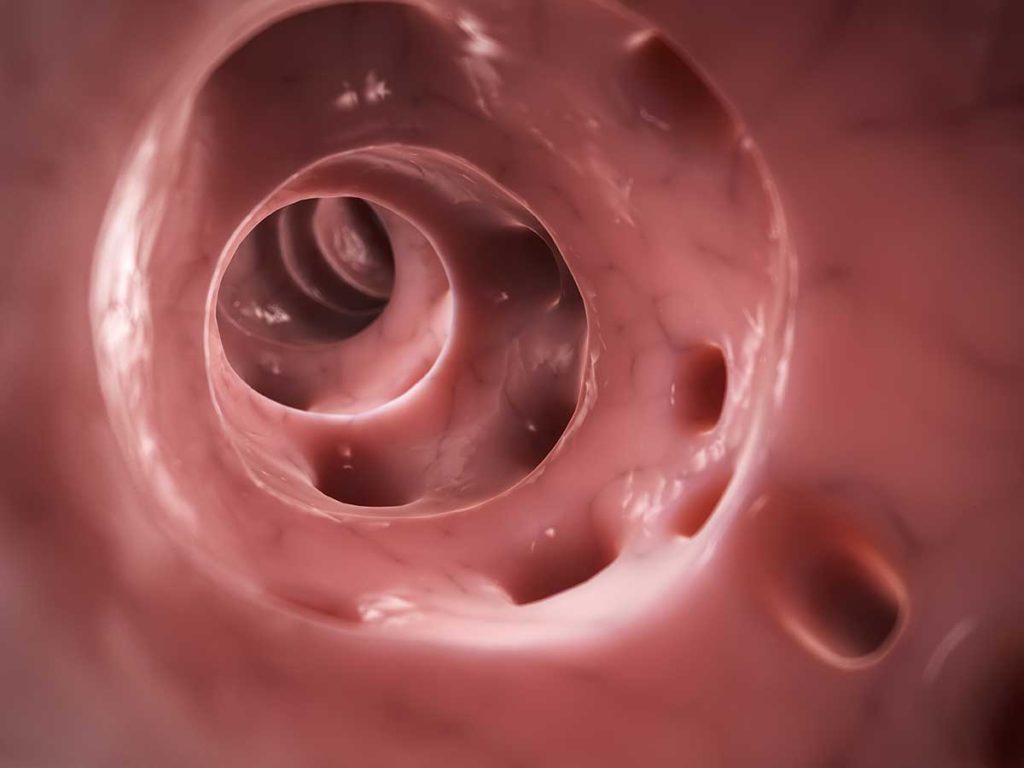 A 3-D rendered illustration of diverticulitis, showing multiple bulges in the colon wall.