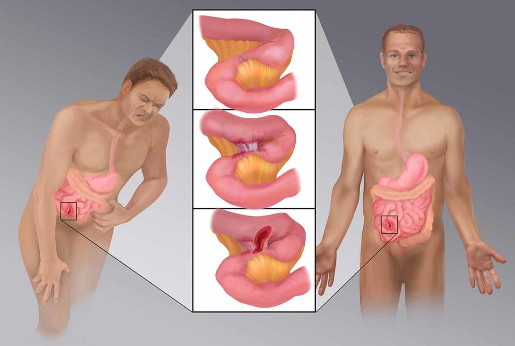 Medical illustration showing man bent over in pain who has normal visceral pain perception and man standing straight who has reduced visceral pain perception. Illustrations between the two men depict strictures, fistulae and abscesses.