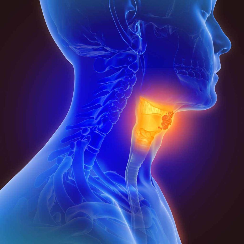 Stylized artwork showing an X-ray view of throat cancer. Tumor is highlighted in orange.