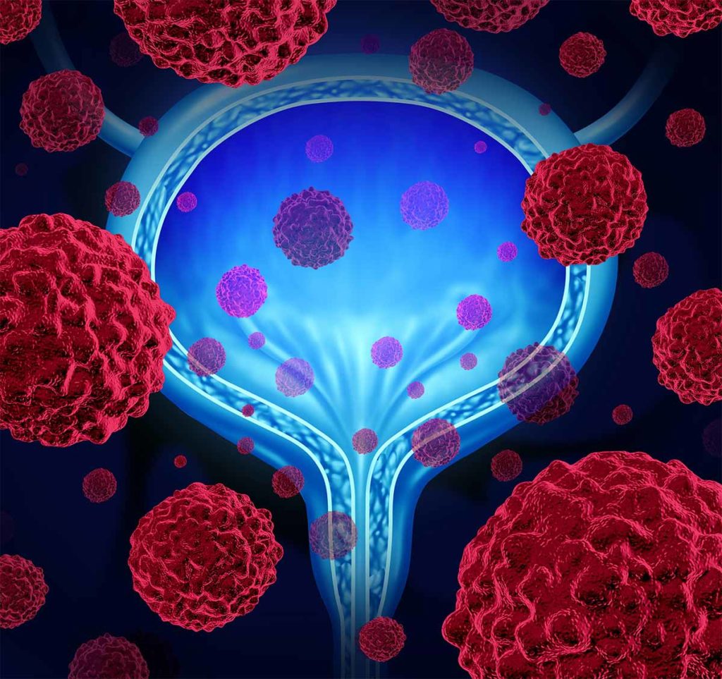 3D illustration of bladder cancer with microscopic cancerous malignant cells spreading in the human body
