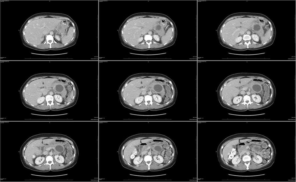Abdomen CT scan with view of pancreatic cyst