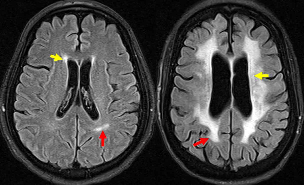 FLAIR images from a brain MRI show locations of white matter hyperintensities. Yellow arrows point to periventricular white matter lesions, and red arrows point to deep white matter lesions.