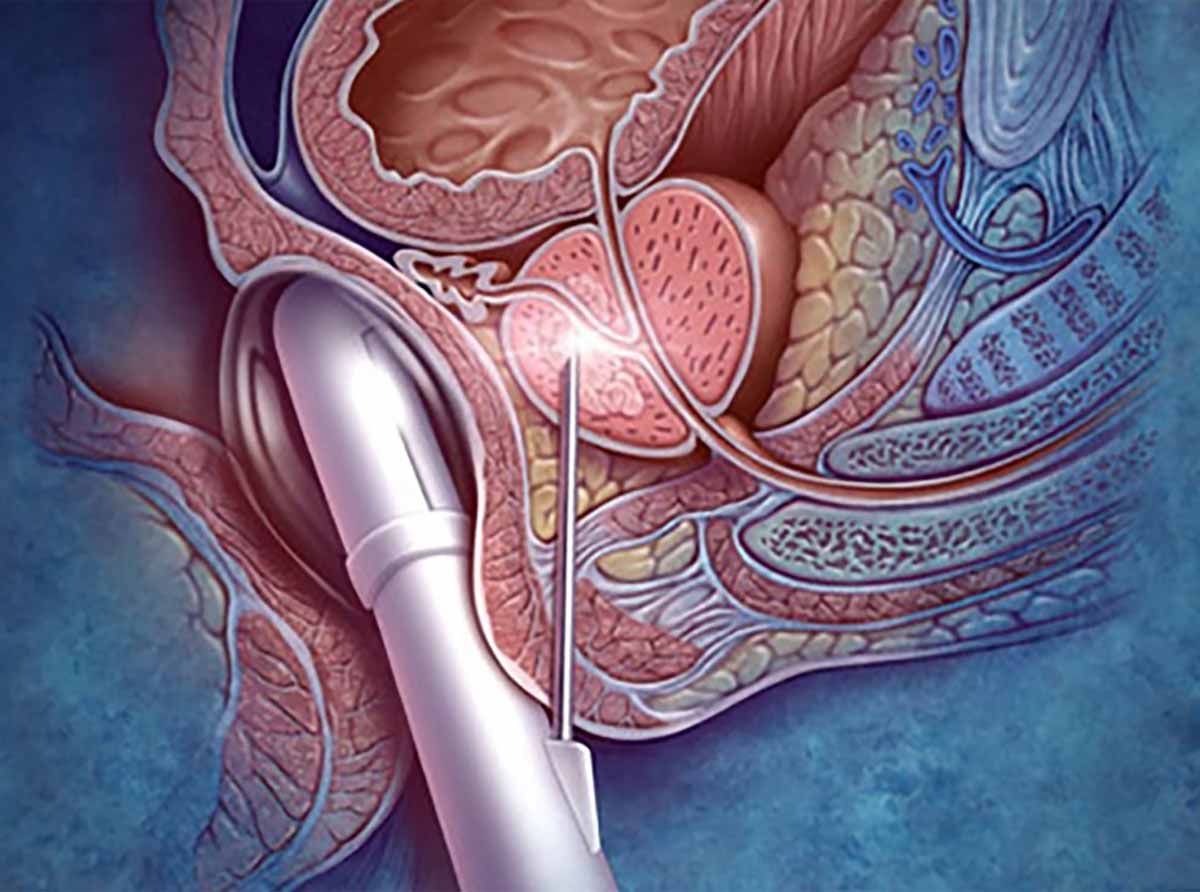 A stylized illustration of transrectal prostate needle biopsy.